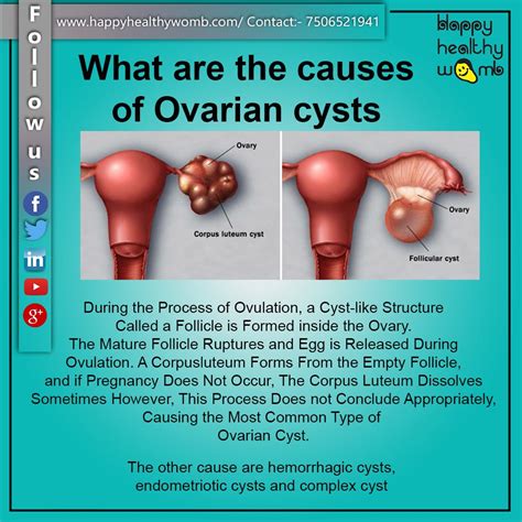 Constipation - sometimes for 5 days. . 4cm ovarian cyst reddit